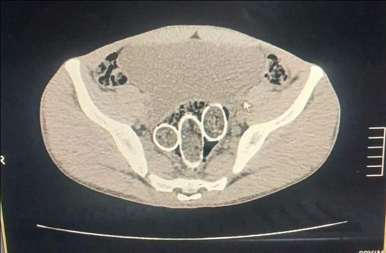 320 Gram Uyuşturucuyu Mide Ve Rahme Sakladılar